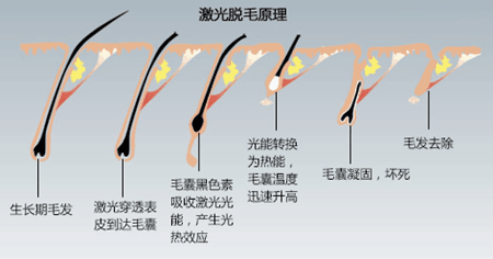 激光脱毛的四大不好 时尚频道 手机搜狐