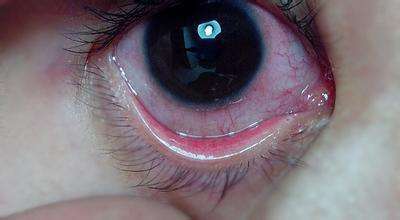 眼睛有红血丝是什么原因 怎么消除眼睛红血丝 健康频道 手机搜狐