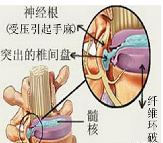 颈椎压迫神经致手麻该怎么办 一招教你搞定 健康频道 手机搜狐