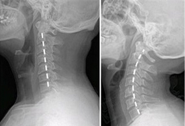 颈椎压迫神经致手麻该怎么办 一招教你搞定 健康频道 手机搜狐