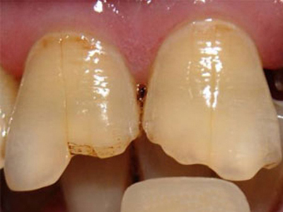 洗牙疼吗 洗牙对牙齿好吗 健康频道 手机搜狐