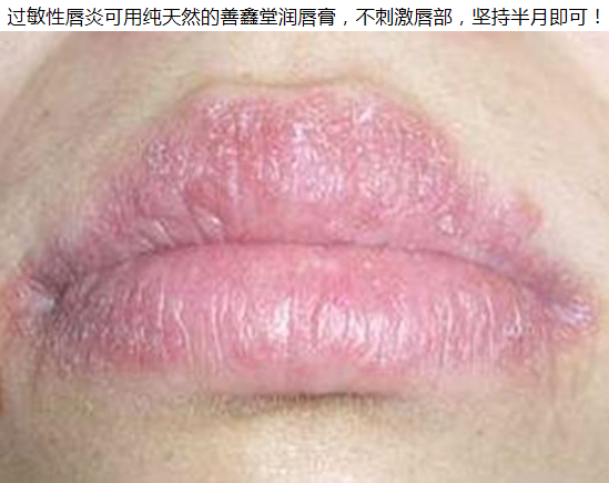 过敏性唇炎的治疗 教你安全护理 健康频道 手机搜狐