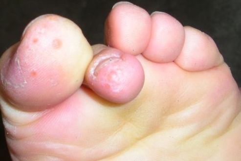 足癣(脚气)治疗应该注意的问题