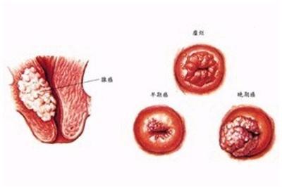 外阴肿瘤症状图片图片