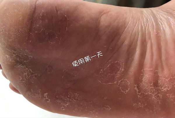 腳氣怎麼辦?幼兒教師親訴治癒腳氣全過程