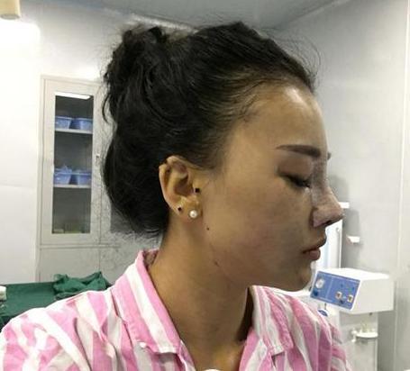 自体软骨隆鼻,鼻子翘出了满意的高度