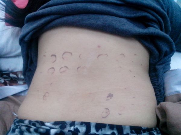 盘点吓人的减肥法,吃蛔虫卵割胃电击