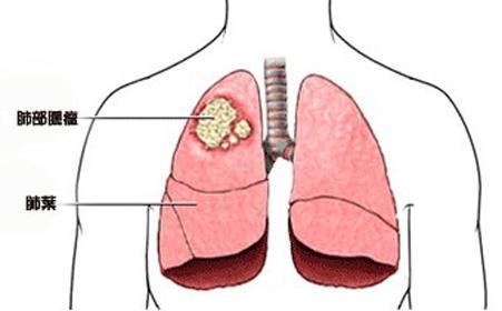 肺部磨玻璃结节 高度警惕肺癌 健康频道 手机搜狐