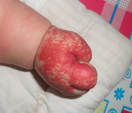 婴儿腿上红色血管瘤图片