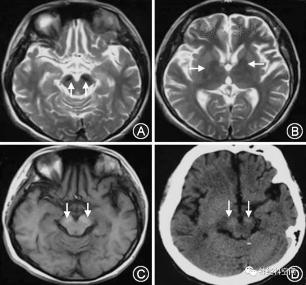 脑组织铁沉积神经变性病诊治专家共识
