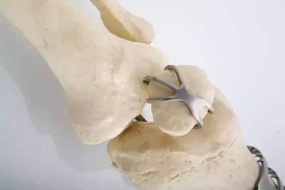 是一种轻质高强度耐蚀结构材料 ▼ 骨科常用的髌骨爪就是用钛金属制成
