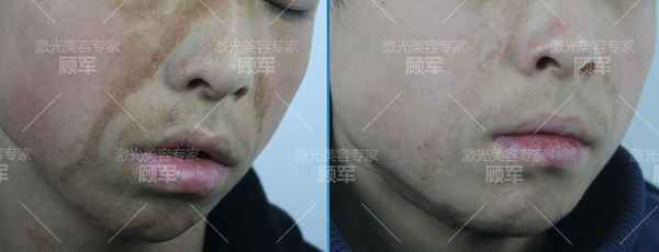 晒伤后留下的色素沉着 能自行消退吗 健康频道 手机搜狐