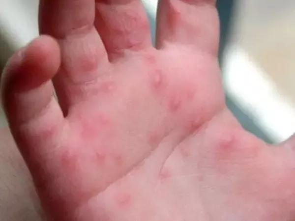 手足口病高发季来了 小心孩子被盯上 母婴频道 手机搜狐