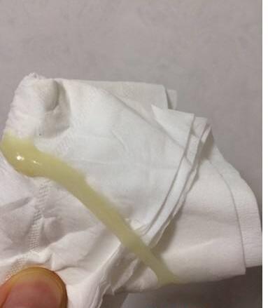 白带为什么是黄绿色