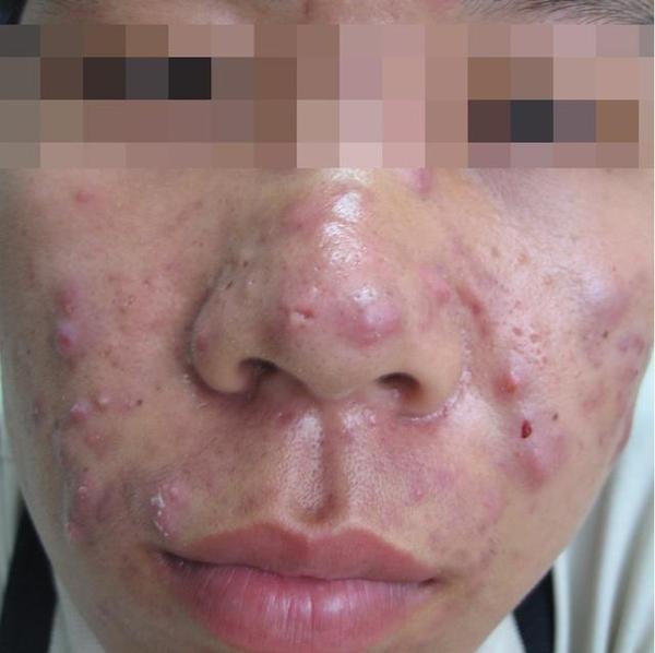 丘疹性痤疮 以发炎的小丘疹为主,高出皮肤大小犹如米粒到豌豆大,较