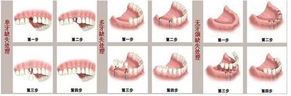 种植牙可以像真牙那样牢固吗 健康频道 手机搜狐