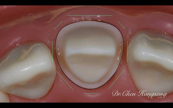 【课程招募】美学修复基础之口腔摄影 前牙牙体预备(全瓷冠 贴面)