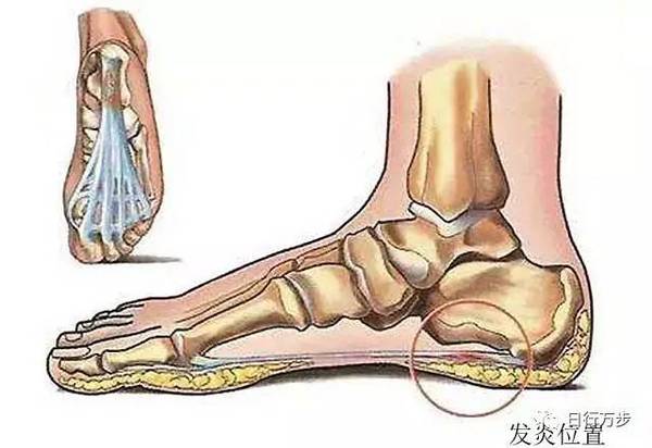 走路脚跟疼 元凶竟然是它 教你几招 脚踏实地 不再难 新闻频道 手机搜狐