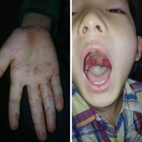 还有十几天,将会有很多孩子感染手足口病.