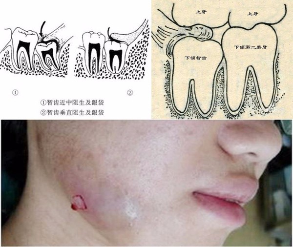 案例 智齿一定要拔吗 新闻频道 手机搜狐