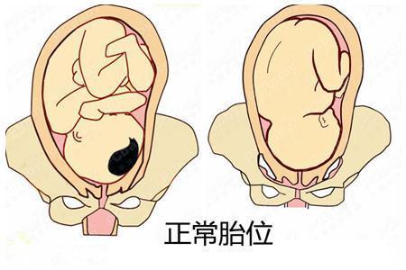正常胎位是什么胎位?
