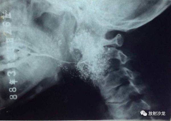 腮腺造影正位片