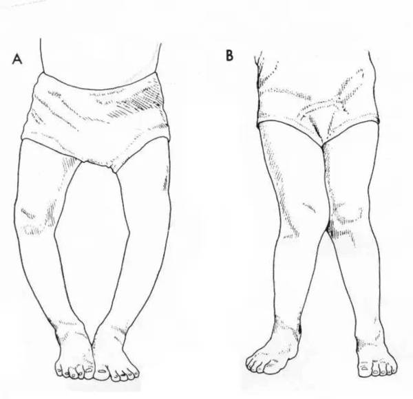 宝宝走路不对劲 是内八 外八 扁平足吗 母婴频道 手机搜狐