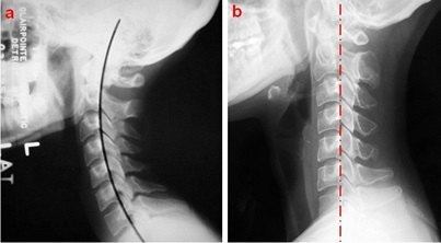 刀下留人 颈椎病能彻底治愈吗 手术治疗风险 健康频道 手机搜狐