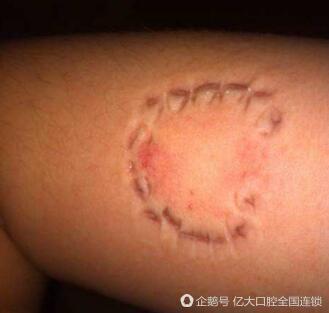 人的牙齿有没有毒 我手臂被人咬了 咬的地方肿了 健康频道 手机搜狐