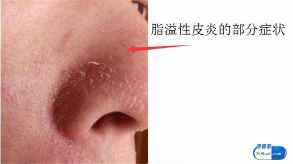 鼻子两侧有红血丝是咋回事 试下这些好方法吧 健康频道 手机搜狐