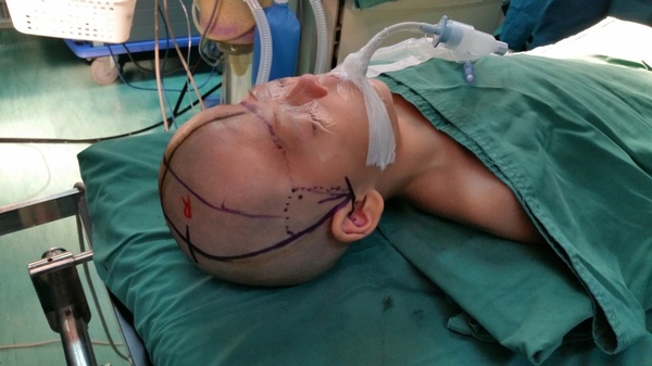 贺晓生教授手术回放:儿童头颅畸形的手术治疗