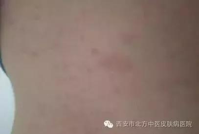 皮肤瘙痒 起红疹 心情低落易引起的皮肤病哦 健康频道 手机搜狐