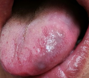 乙肝病毒舌头图片图片