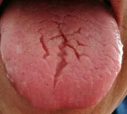 肝病舌苔大总结
