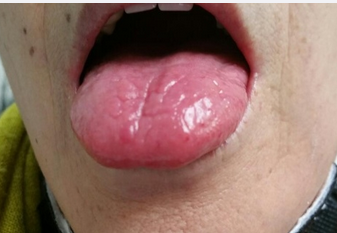 肝瘿线舌头图片