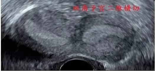 3.双角子宫