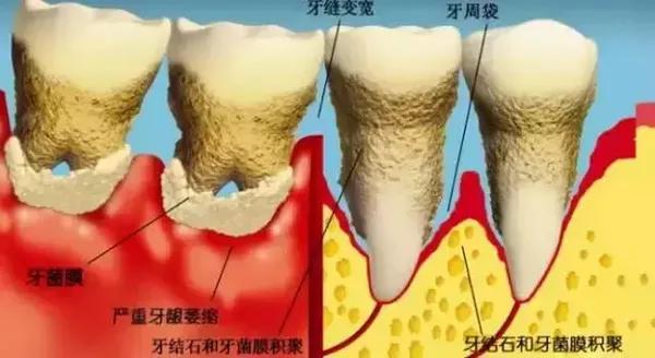 中度牙周炎:出現咀嚼無力,口臭,牙齦退縮,牙根暴露,出現牙縫,牙床腫痛