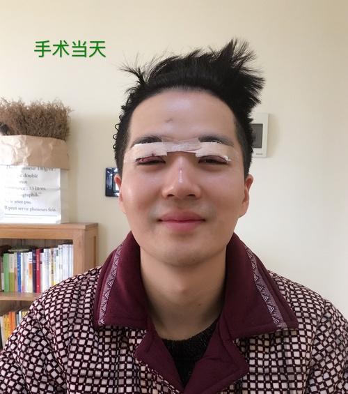 男生全切双眼皮,自然一点,宁窄勿宽