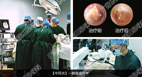 3,微创手术切口小,适用范围广:分泌性中耳炎微创治疗术前无需剃头发