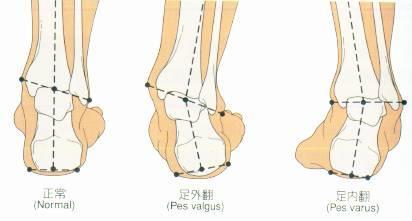 如何辨别足内翻 足外翻 健康频道 手机搜狐