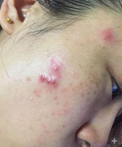 2,脸上长痘,长斑和内分泌失调