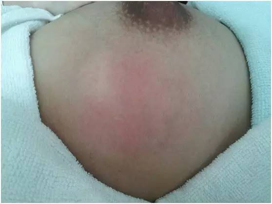 比生孩子还疼的乳腺炎 新手妈妈应该如何预防 治疗 新闻频道 手机搜狐