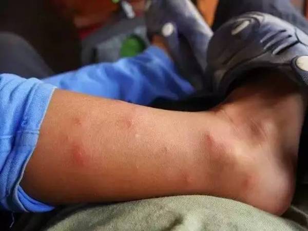 来之前,辛巴一家还打了黄热,疟疾疫苗.