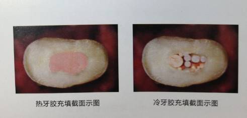热牙胶填充与冷牙胶填充对比图