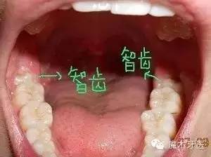 智齿拔不拔 我说100次不如央视说1次 新闻频道 手机搜狐