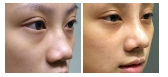 华悦府 详解驼峰鼻的修复 健康频道 手机搜狐