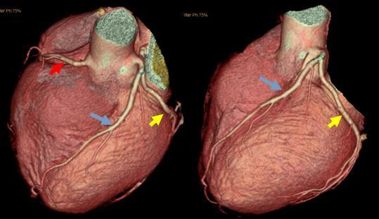 冠状动脉彩图图片