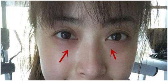 黑眼圈一定是黑色的吗 黑眼圈的3类型和4个误区 时尚频道 手机搜狐