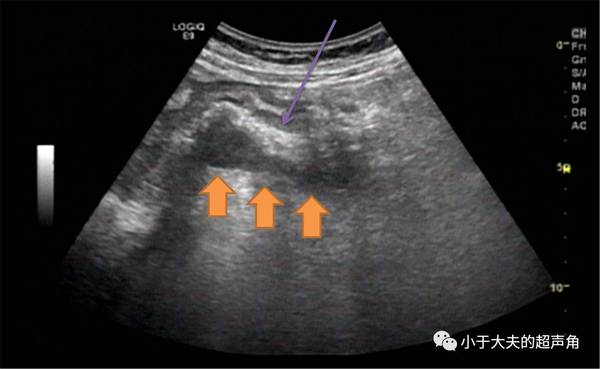 超声 常规腹部超声亦可发现胃部病变 病例分享 新闻频道 手机搜狐