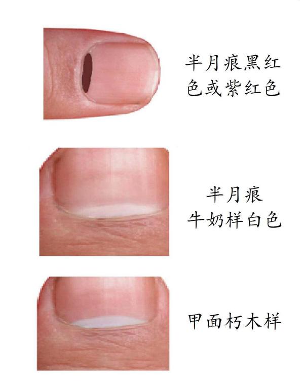 这52种指甲 潜伏着52种健康危机 其中5种可致命 健康频道 手机搜狐